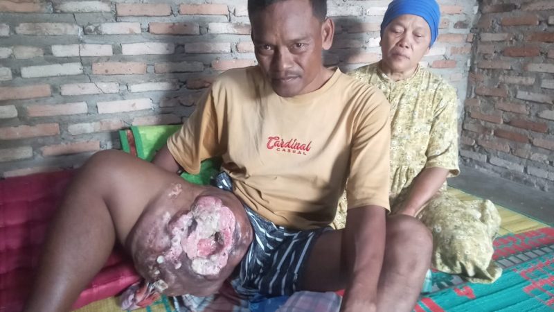 Minta Penyakit Tumor Seberat 3 Kg Segera Dioperasi, Rudi Nainggolan Minta Uluran Tangan Bupati Asahan